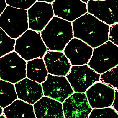 macular degeneration and stem cells