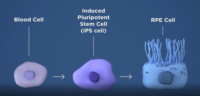 macular degeneration and stem cells