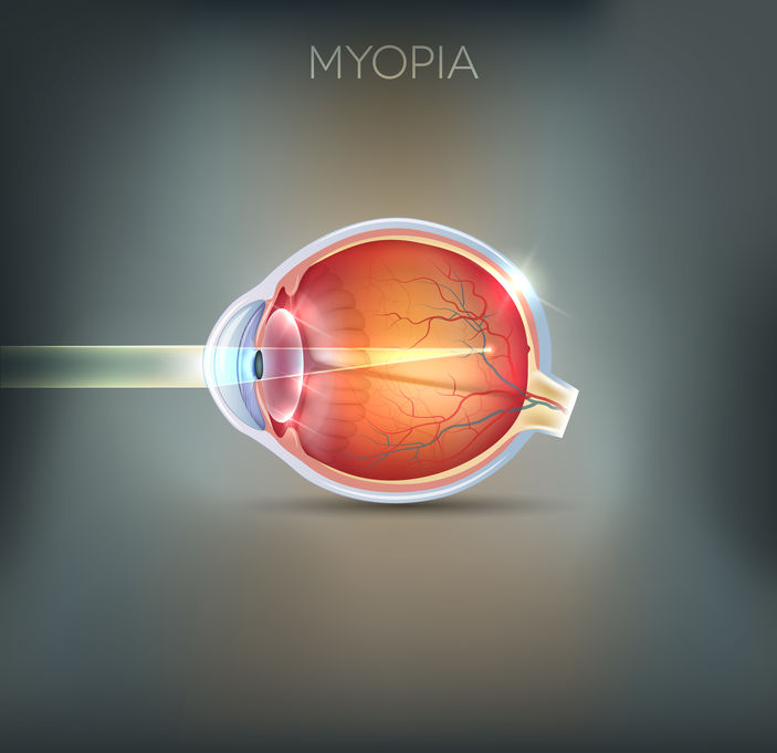 myopic macular degeneration