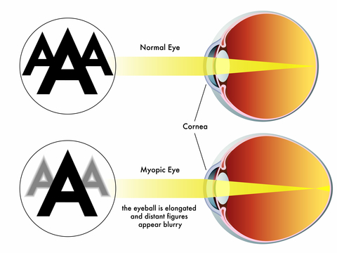 myopic macular degeneration