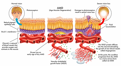 what is wet macular degeneration