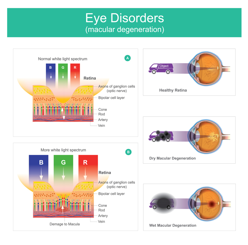 Stages Of Macular Degeneration