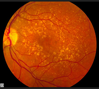 dry to wet macular degeneration