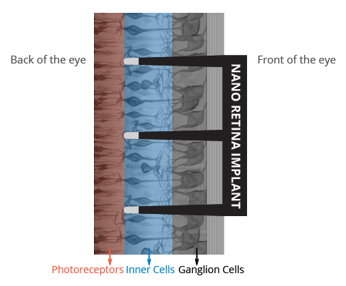 retina implant