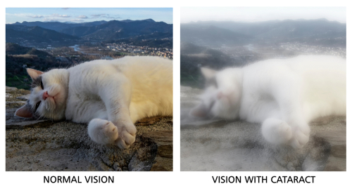 symptoms of cataracts