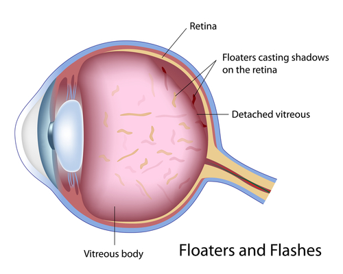 what are eye floaters