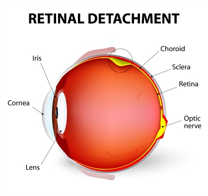 what is a detached retina