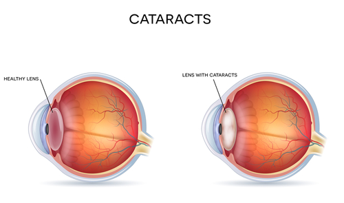 blue light and macular degeneration