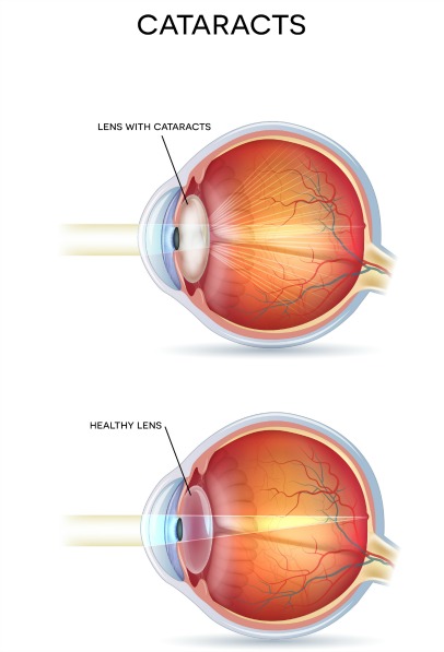 cataract prevention