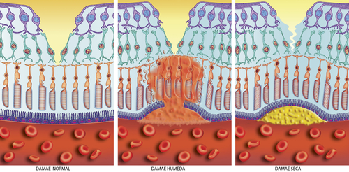 wet vs dry macular degeneration