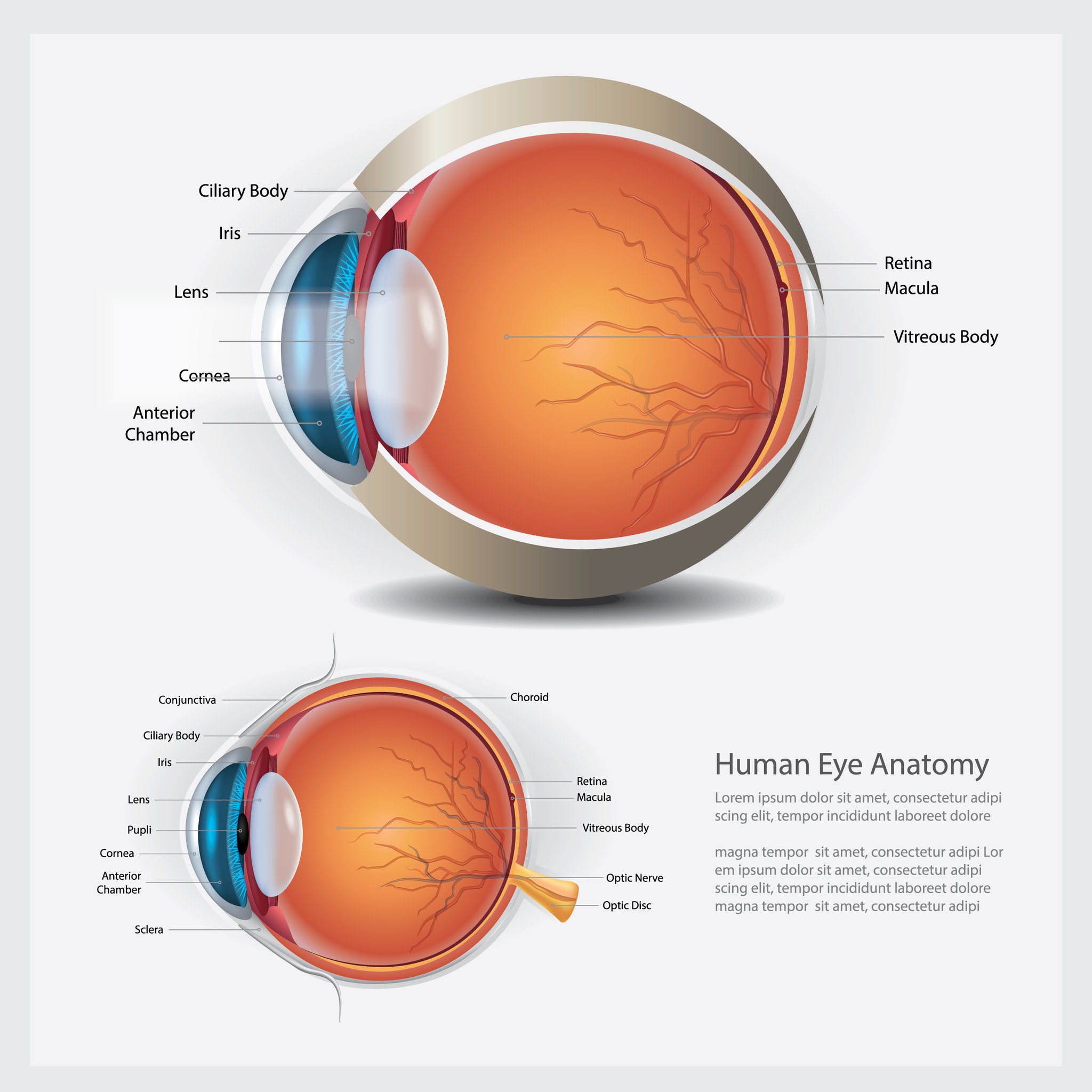 macular pucker