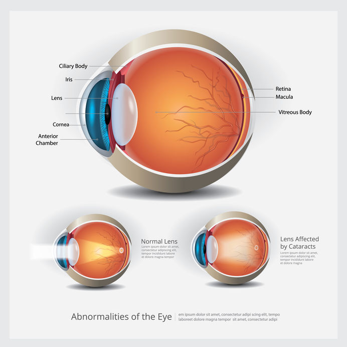 Cataracts and Macular Degeneration