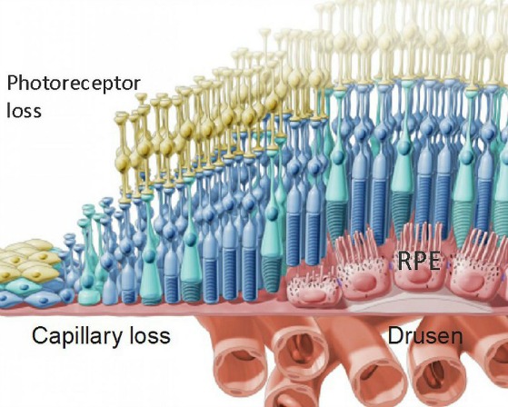 macular degeneration stages