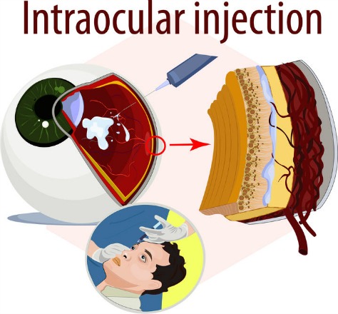 eye injections for wet macular degeneration