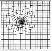 macular edema