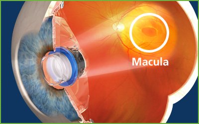 macular degeneration implant