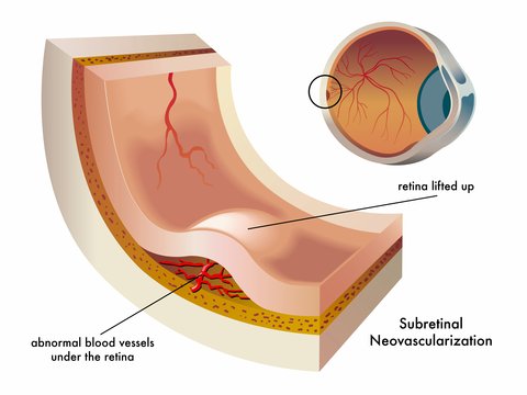 choroidal neovascularization