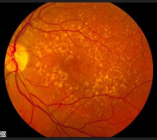 definition of macular degeneration