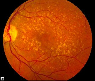 macular degeneration stages
