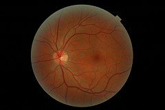 macular pigment