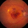 wet macular degeneration