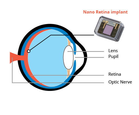 retina implant
