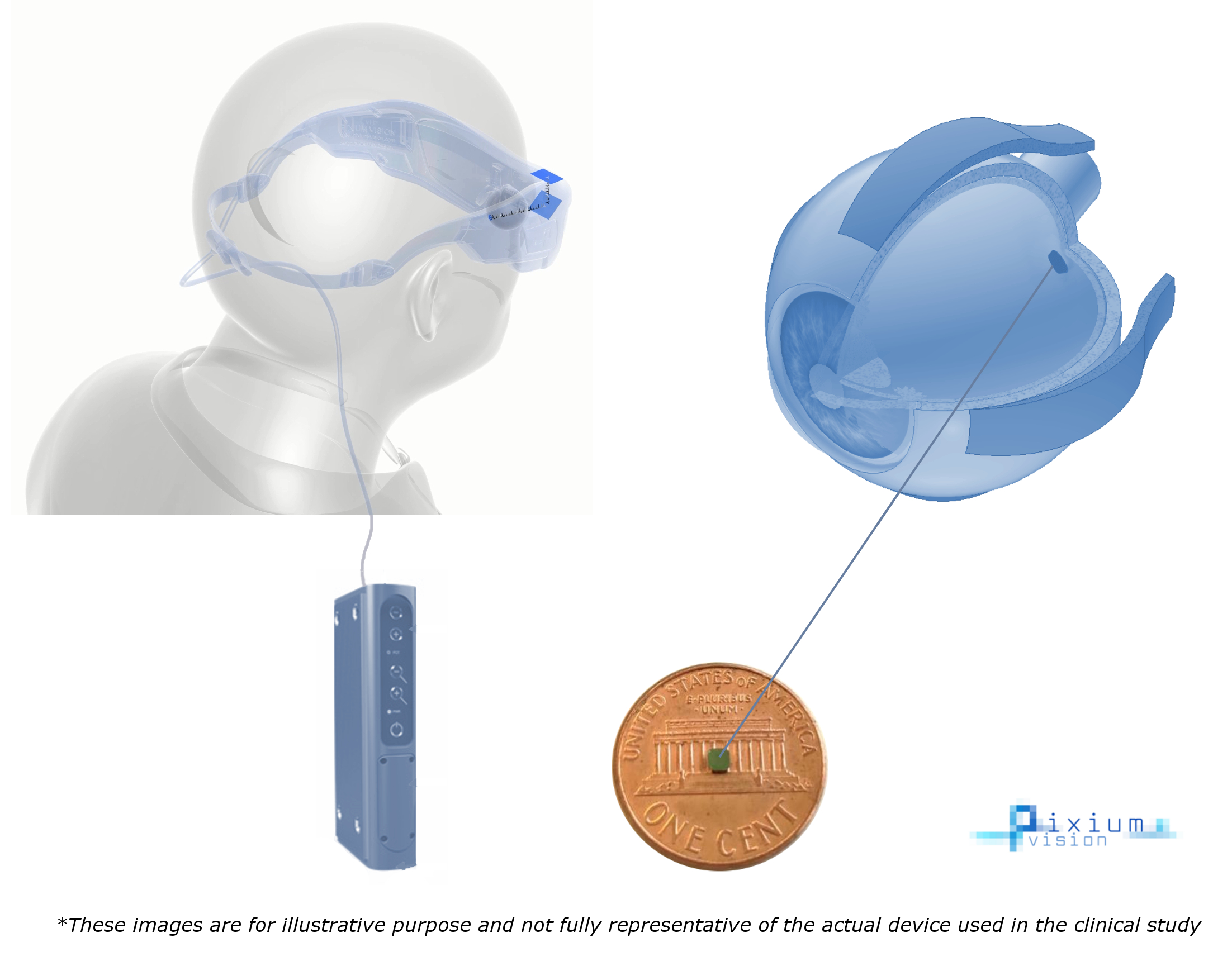 macular degeneration treatment breakthrough