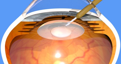 cataracts and macular degeneration