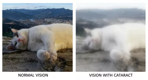 symptoms of cataracts