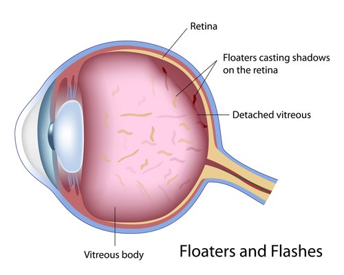 what are eye floaters