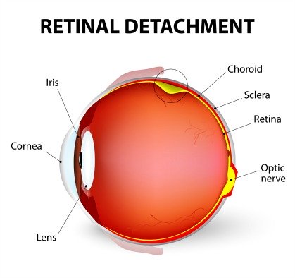 what is a detached retina