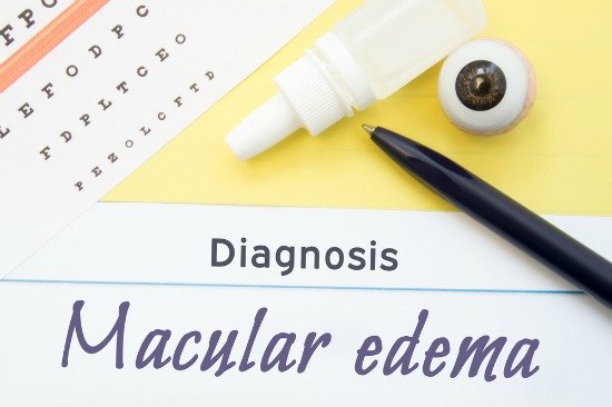 macular edema