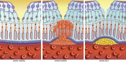 stages of macular degeneration